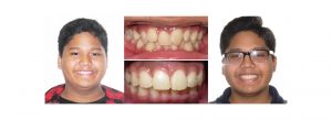 before and after orthodontics