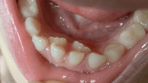 shark teeth - Surfside Kids Dental