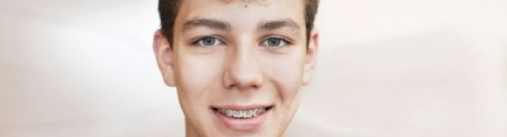 Rubber Band Tips For Orthodontic Patients - Orthodontist Dublin and Gahanna